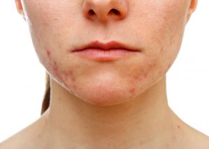 bottom half of a woman's face showing acne on her jaw area