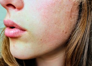 close up of a woman's cheek with dehydrated and unhealthy looking skin