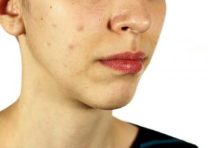bottom half of a woman's face showing her dull and spotty skin