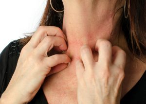 woman scratching a red rash on her neck