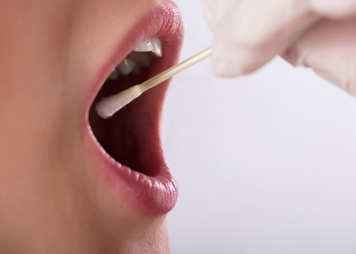 woman with her mouth wide open and a doctor taking a saliva swab for a food intolerance test