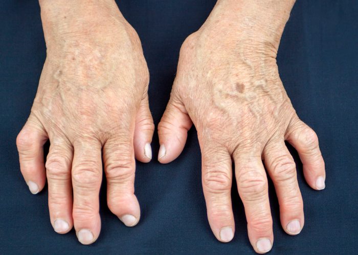 Elderly woman's hands deformed by rheumatoid arthritis autoimmune disease