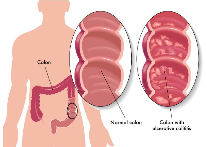 Diagram showing a normal colon and a colon with ulcerative colitis autoimmune disease