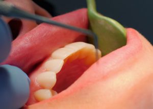 Dentist working on someone's teeth