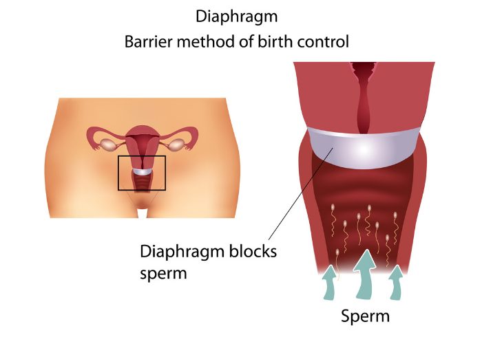 Diagram showing how a diaphragm or barrier method of birth control works