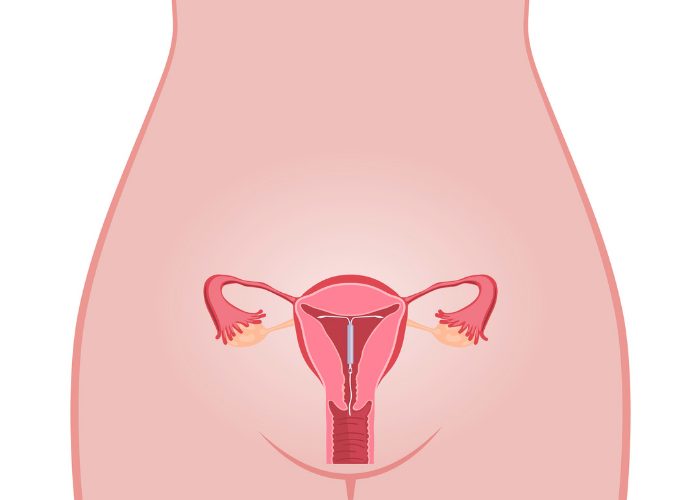 Diagram of a woman's reproductive system with an inserted IUD, showing how an IUD works