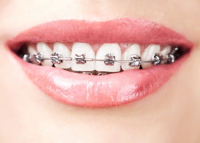 Close up on an adult woman's mouth smiling with metal bracket braces