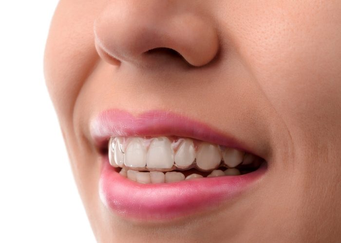 Close up of woman's mouth with invisible Invisalign adult braces