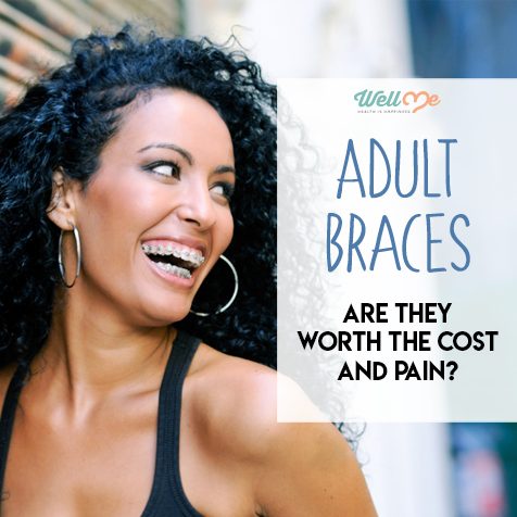 Adult Braces: Are They Worth the Cost and Pain
