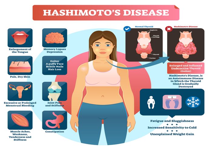 Graphic showing the symptoms of Hashimoto's Disease