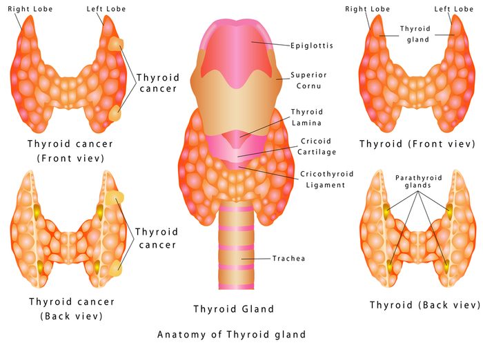 Diagram of a healthy thyroid vs a thyroid with cancer