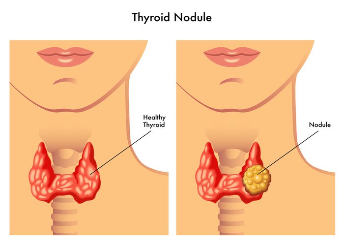 Graphic of a healthy thryoid vs a thyroid with a nodule