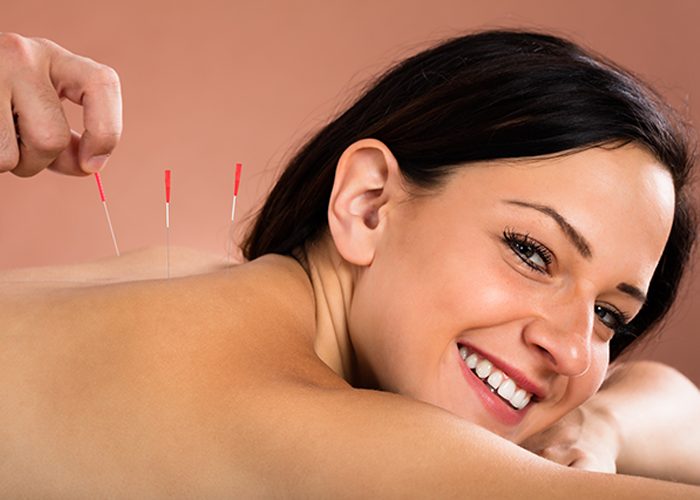 Woman with acupuncture needles in her back smiling