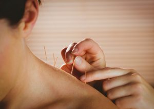 Acupuncture needles being placed in the back of a woman's neck and shoulders