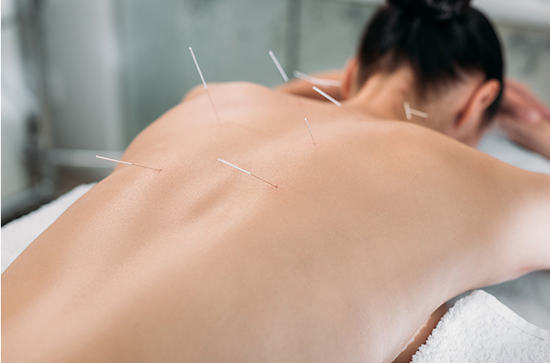 woman's back with acupuncture needles in her back