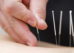 Close up of a practitioner placing acupuncture needles in a body