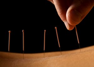 Close up of acupuncture needles in the back of a patient