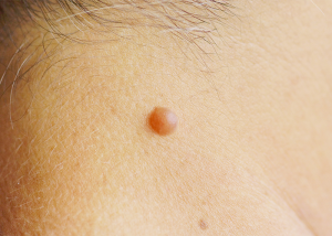 Close up of a large mole on the back of a woman's neck.