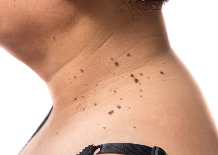 Close up of a woman's neck and shoulder where many moles of different shapes and sizes are growing.