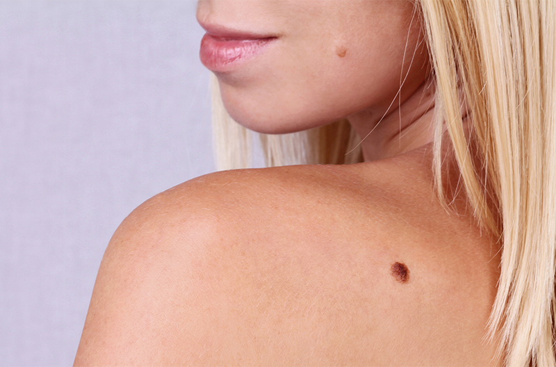 close up of a woman's shoulder with a visible mole on it