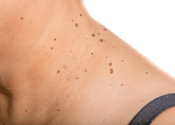 Woman with an excessive number of moles on her neck.