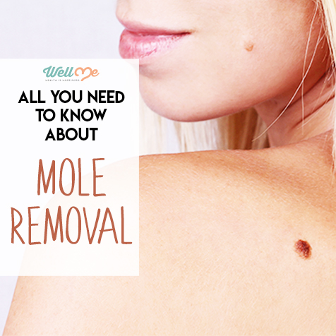 All You Need to Know About Mole Removal