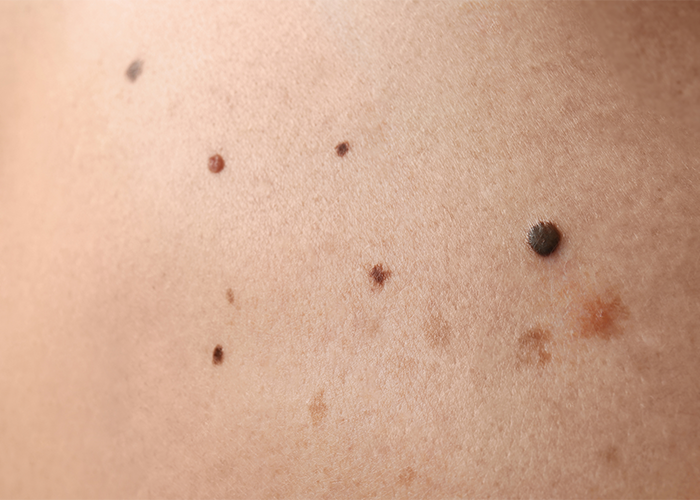 A variety of different moles and blemishes on a patch of skin.