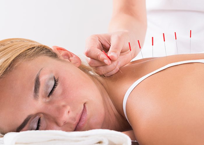 Woman with eyes closed receiving acupuncture treatment on her back