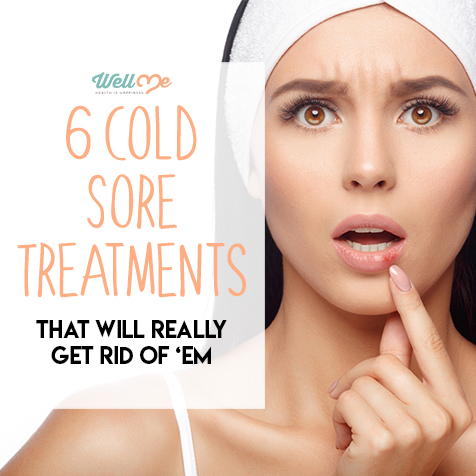 6 Cold Sore Treatments That Will Really Get Rid of 'Em