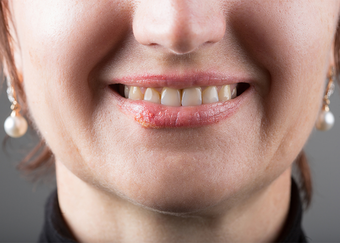 A woman with a cold sore smiling