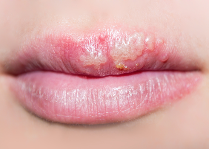 Close up of a woman's lips that are blistered because of a cold sore