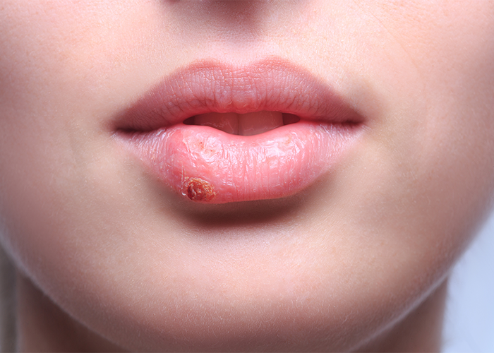 Close up of a woman's lips that are are crusting because of a cold sore