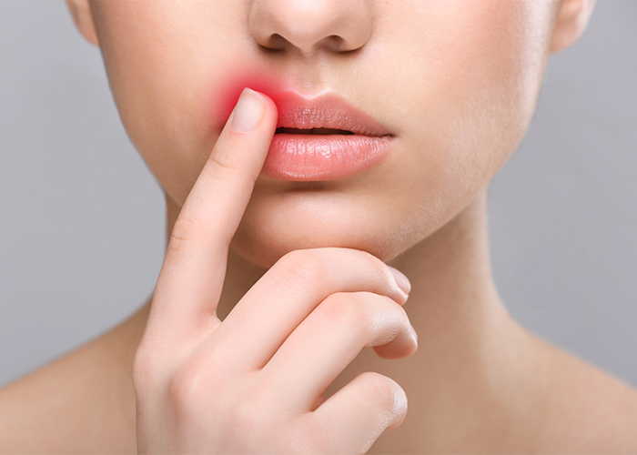 Woman with a cold sore on her mouth touching it with her index finger