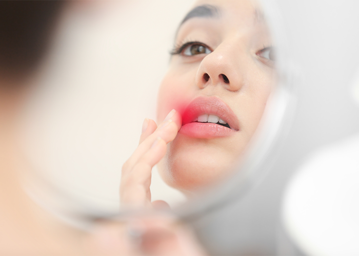 Woman looking into a mirror touching her cold sore