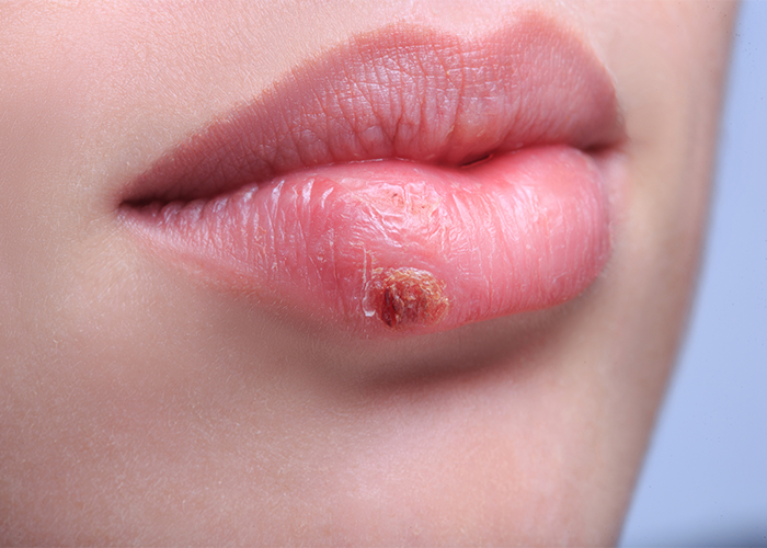 Close up of a woman with a cold sore on her lips