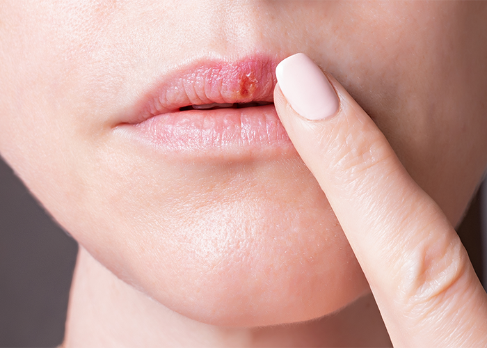 Close up of a woman touching her cold sore on her lips with her finger