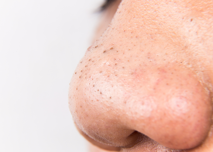 Close up of woman's nose with blackheads