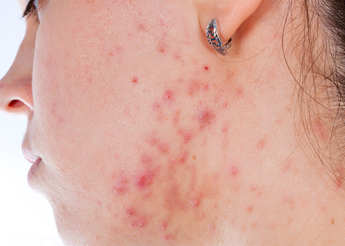 Close up of a woman's profile and neck covered in acne