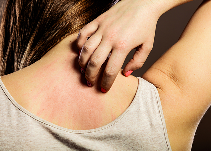Woman scratching rashes caused by lupus on her back