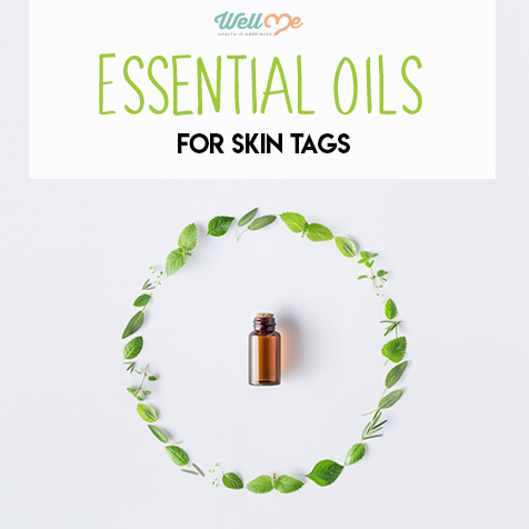 Essential Oils for Skin Tags