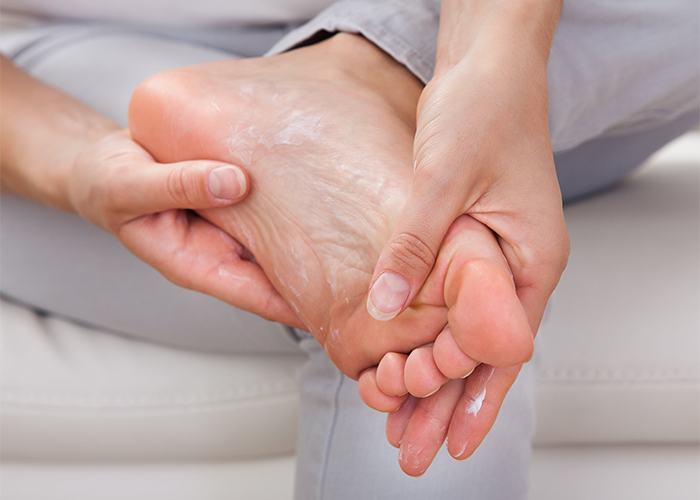 Woman rubbing her foot with manuka essential oil anti-fungal cream