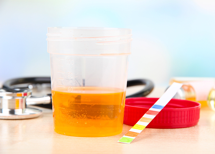 A cup of urine on a doctor's table next to a urine strip test 