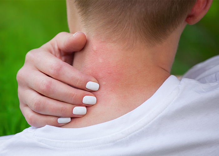 woman-scratching-red-swollen-neck-skin-from-mosquito-bites