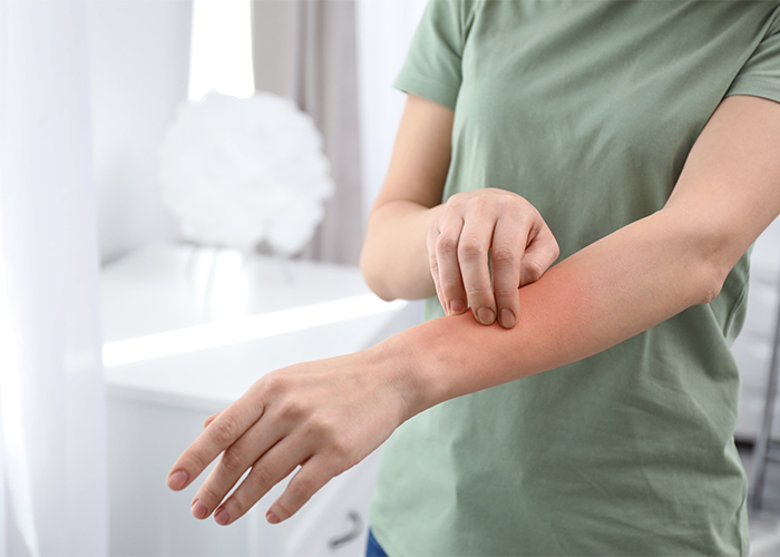 woman-with-allergy-symptoms-scratching-forearm